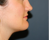 Feel Beautiful - Chin Reduction And Liposuction Beneath The Chin 205 - After Photo
